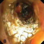 Pseudomembranous seen overlying the bronchial mucosa (Tasci 2006).