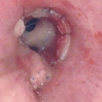 Obstructing tracheobronchitis. Mucus plugs seen obstructing the lumen of the bronchi (Kramer 2005).