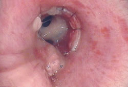 Obstructing tracheobronchitis. Mucus plugs seen obstructing the lumen of the bronchi (Kramer 2005).
