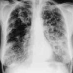 Chest X-ray showing poorly defined bilateral nodular opacities (Al-Alawi 2007).