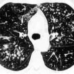 Figure 6: High resolution CT showing centrilobular nodular opacities and branching linear opacities (tree-in-bud appearance) (Al-Alawi 2007).
