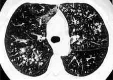 Figure 6: High resolution CT showing centrilobular nodular opacities and branching linear opacities (tree-in-bud appearance) (Al-Alawi 2007).
