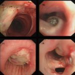 Bronchoscopic manifestations of <em>Aspergillus</em> tracheobronchitis. (a) Type I. Inflammatory infiltration, mucosa hyperaemia and plaques of pseudomembrane formation in the lumen without obvious airway occlusion. (b) Type II. Deep ulceration of the bronchial wall. (c) Type III. Significant airway occlusion by thick mucous plugs full of <em>Aspergillus</em> without definite deeper tissue invasion. (d) Type IV. Extensive tissue necrosis and pseudomembrane formation in the lumen with airway structures and severe airway occlusion (Wu 2009).
