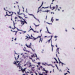 Bronchoscopic biopsy demonstrated septate hyphae with branching at 45o (methenamine silver stain ×400).