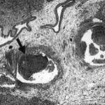 fibrinonecrotic material (arrow) from the airway shown in A, with subocclusion of the bronchial lumen (*);