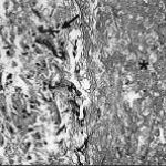 Aspergillus hyphae (arrow) in the lumen without invasion of the necrotic bronchial wall (*) (Nicod 2001).