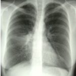 Image A. 4/4/96 Her chest X-ray shows collapse and consolidation, probably of her right middle lobe.