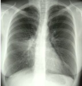 Image A. 4/4/96 Her chest X-ray shows collapse and consolidation, probably of her right middle lobe.