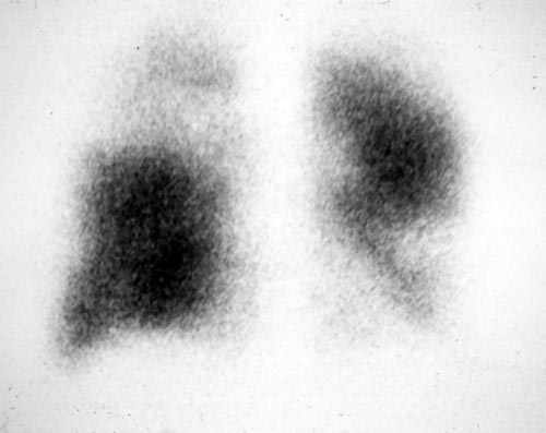 Lung perfusion scan, pt RR