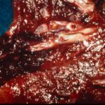 Pulmonary infarction