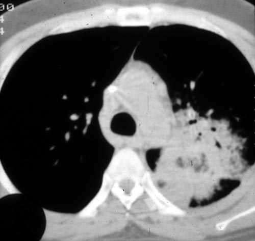  Pneumothorax (left) in a leukaemia patient 