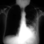 Severe unilateral invasive aspergillosis of the left lung