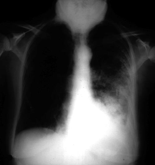 Severe unilateral invasive aspergillosis of the left lung