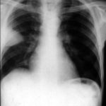 Chest radiograph with 'classical' appearance of a pulmonary infarction