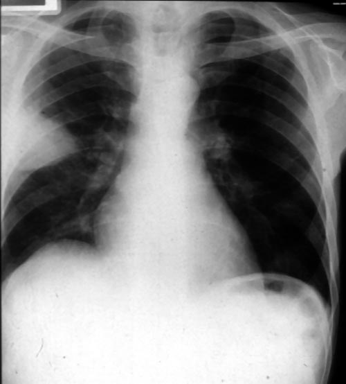 Chest radiograph with 'classical' appearance of a pulmonary infarction