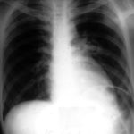 Chest radiograph showing a new cavitary lesion