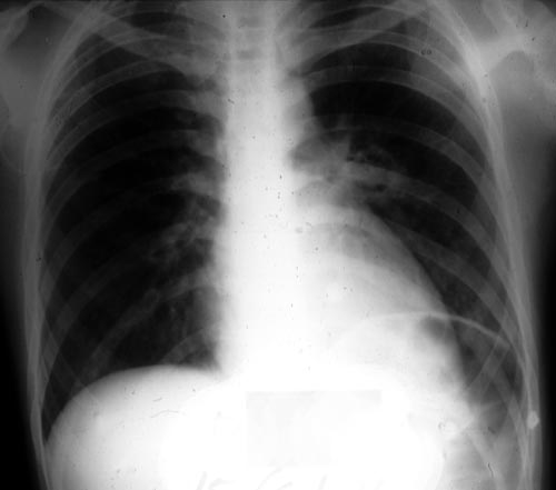 Chest radiograph showing a new cavitary lesion