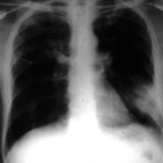 Image A. Chest radiograph of a leukaemic man showing an area of consolidation at the left base, abutting on the pleura and some faint soft shadowing at the right apex. 