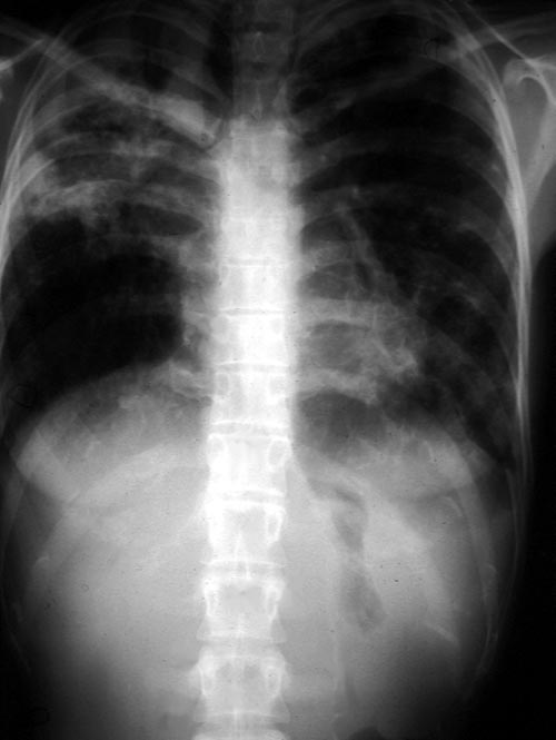 Image A. IPA in chronic granulomatous disease, Pt, JA