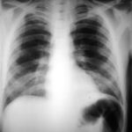Image A. Diffuse bilateral IPA in AIDS, pt JA