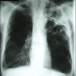 -3-12chestxray