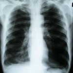 -3yrschestxray