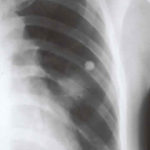 Image A. Chest x-ray shows a single nodule in the left mid lung