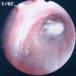 The posterior division of the right upper lobe is completely blocked by a thick white plug.