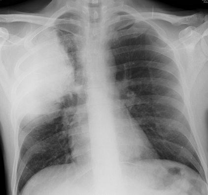 Image 1 08/12/2005 Pneumonia was diagnosed.