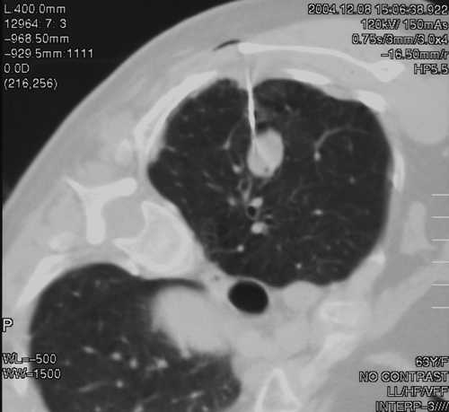 Aspergilloma. Patient EW Percutaneous lung biopsy
