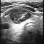 Image A is an ultrasound image of the thyroid showing an irregular fluid-filled mass in the right lobe of the thyroid gland, with deep haemorrhage. His skin is at the top of the image.
