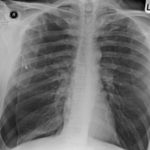 Image A. February 2009 - Chest x-ray showing bilateral apical bullae most marked on the right in association with a right pneumothorax.  A chest drain is in-situ.