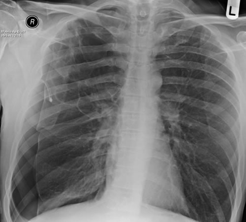 Image A. February 2009 - Chest x-ray showing bilateral apical bullae most marked on the right in association with a right pneumothorax.  A chest drain is in-situ.