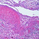 RArthritiswithasposis