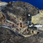 TBaspergilloma2