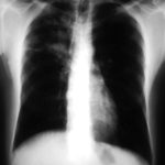 Recurrence of pulmonary shadows 4, pt BJ