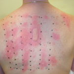 allergytesting