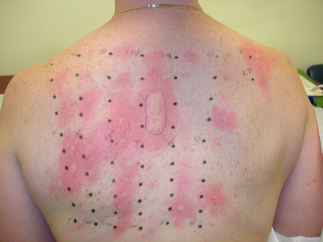 allergytesting