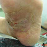 aspnigerfoot1