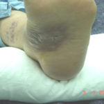 aspnigerfoot2