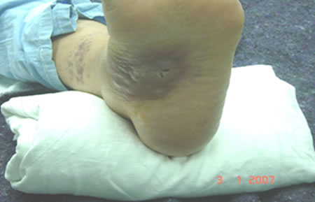 aspnigerfoot2