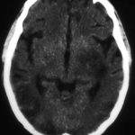 brain1