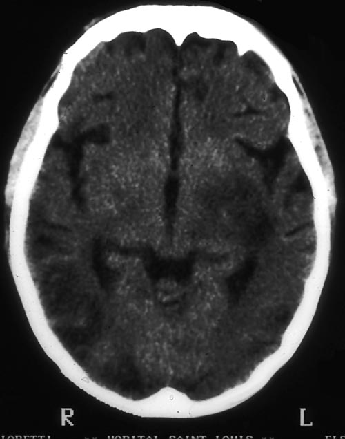 brain1