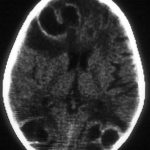 Image A. Contrast enhanced scan of the brain in a 5 year old child who had a convulsion several weeks after starting chemotherapy for acute lymphoblastic leukaemia. 