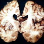 Cerebral aspergillosis - gross pathology, pt DB.
