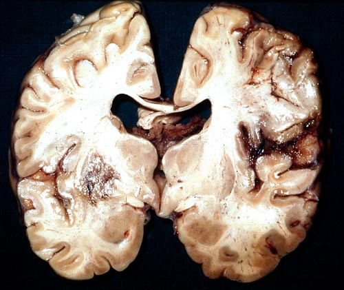 Cerebral aspergillosis - gross pathology, pt DB.