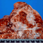 Aspergilloma patient LP. The same patient, revealing the aspect of the cavity without the fungus ball.