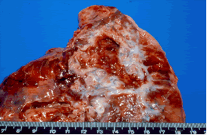 Aspergilloma patient LP. The same patient, revealing the aspect of the cavity without the fungus ball.