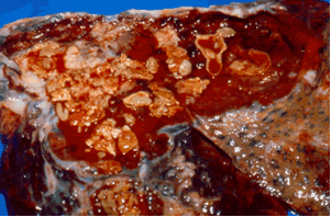 Early fungal colonisation of a cavity by fungi. Gross pathology of a cavity showing yellow thin membranes of mycelia – the beginning of intracavitary colonization.