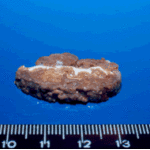 Multiple aspergillomas, Patient CR. The same specimen showed in adjacent figure. Cut section revealing hyphal growth in zones.